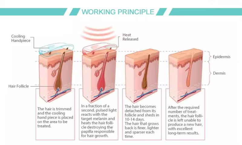 Diode laser hair removal machine